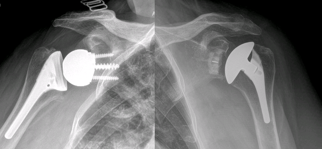 Total Shoulder Replacement
